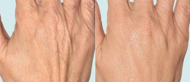 Piel de la mano antes y después del tratamiento segmentario.