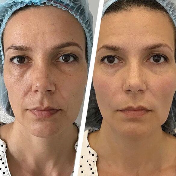 Fotos faciales antes y después del rejuvenecimiento con láser. 